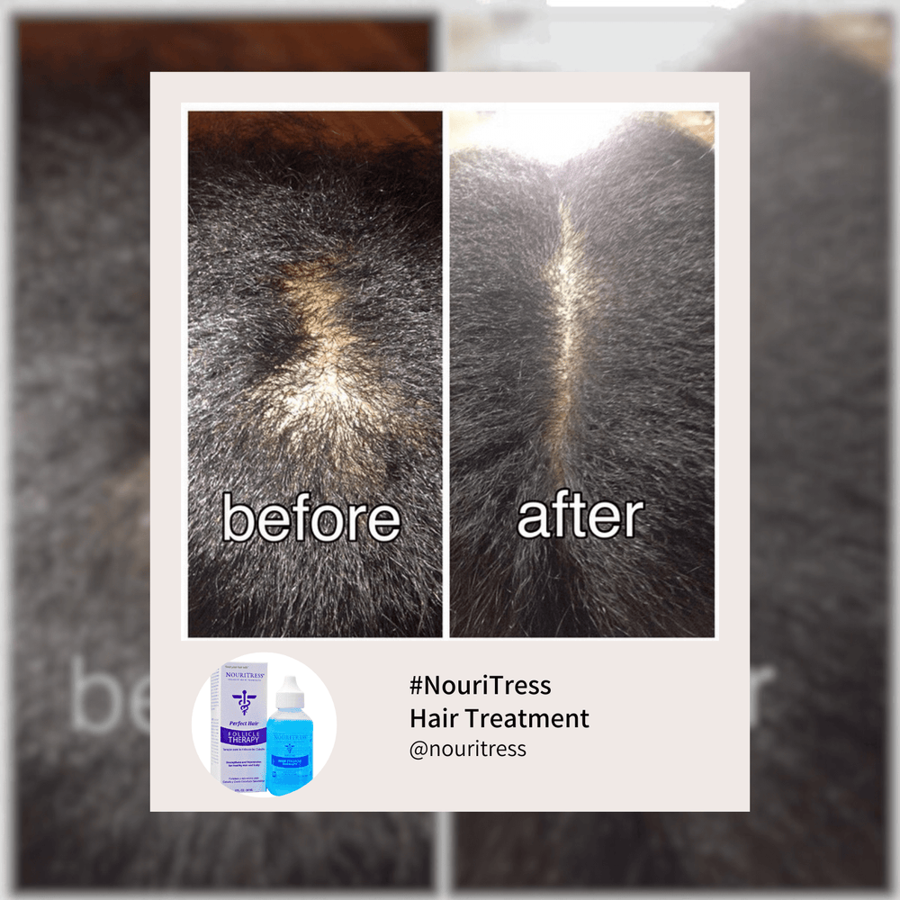 Hair Follicle Therapy Serum - NouriTress Hair Products