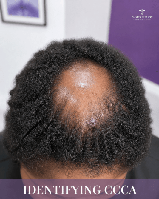 Traction vs. CCCA: 5 Signs of Scarring Alopecia You Can’t Ignore - NouriTress Hair Products